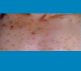 Chickenpox rash